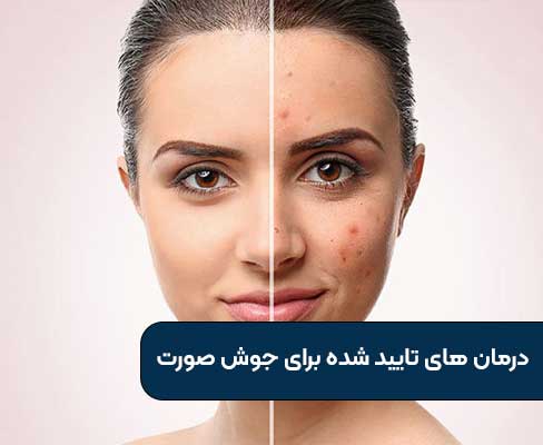درمان های تایید شده برای جوش صورت